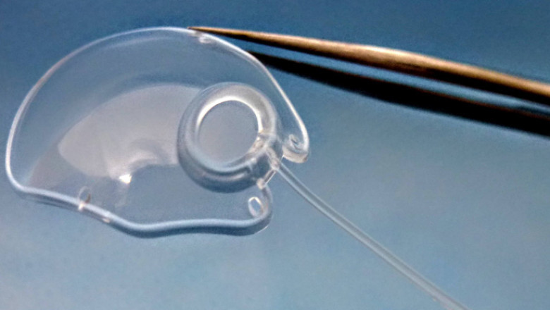Glaucoma Drainage Devices Market Surge on Rising Demand for Minimally Invasive Surgery