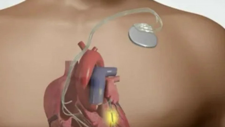 Cardiac Pacemaker Market to Expand with Leadless Technology
