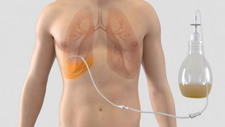 Chest Drainage Catheters Market to Grow at Highest Pace Owing to Rising Thoracic Procedures