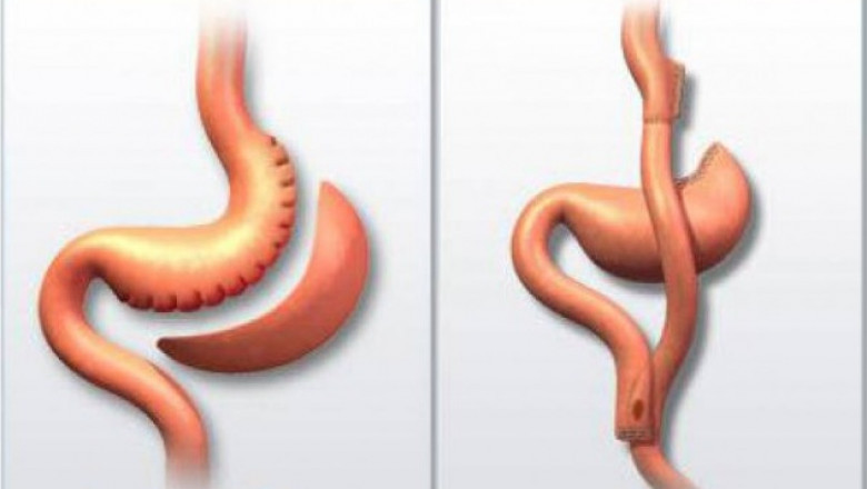 Post Bariatric Hypoglycemia Market to Accelerate Through Novel Therapies