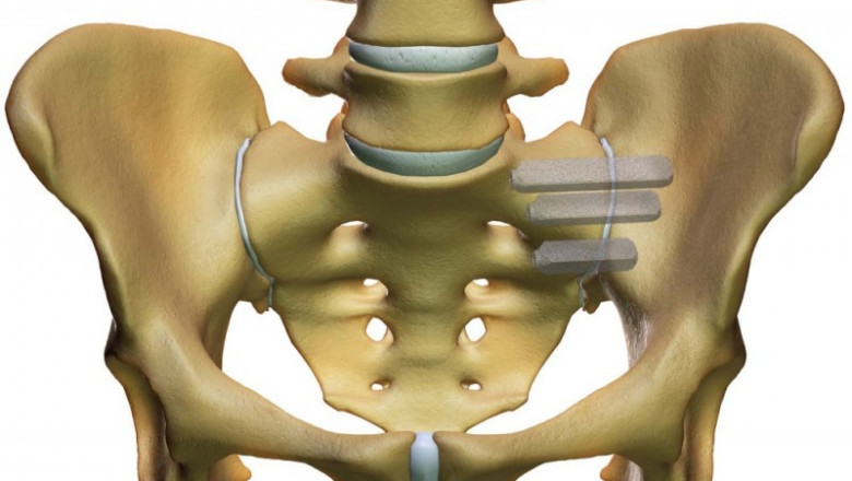 Global Sacroiliac Joint Fusion Market to Accelerate Via Minimally Invasive Advances