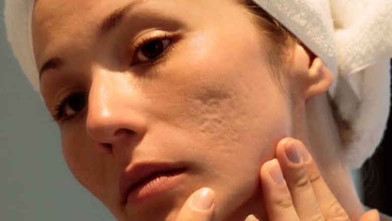 Islamabad’s Rise in Non-Invasive Acne Scars Treatments