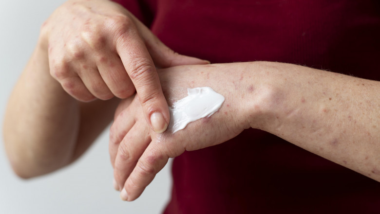 Fungal Infections: The Itch You Didn’t Ask For, But Can Beat