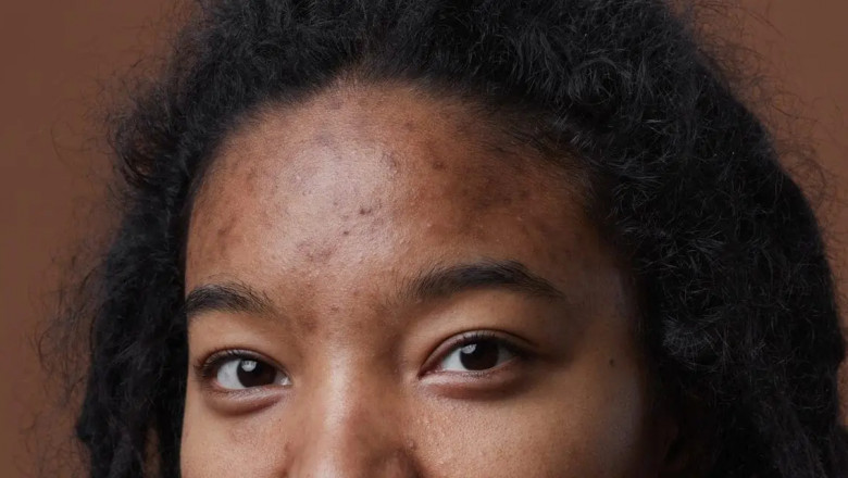 Does Weed Cause Acne? Truth About Smoking Pot and Skin Health