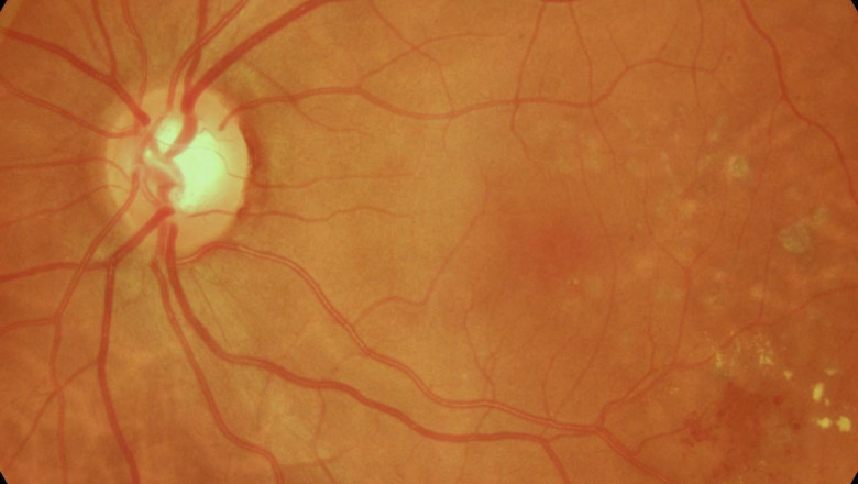 Retinis Pigmentosa Market Will Grow Rapidly Owing to Gene Therapy