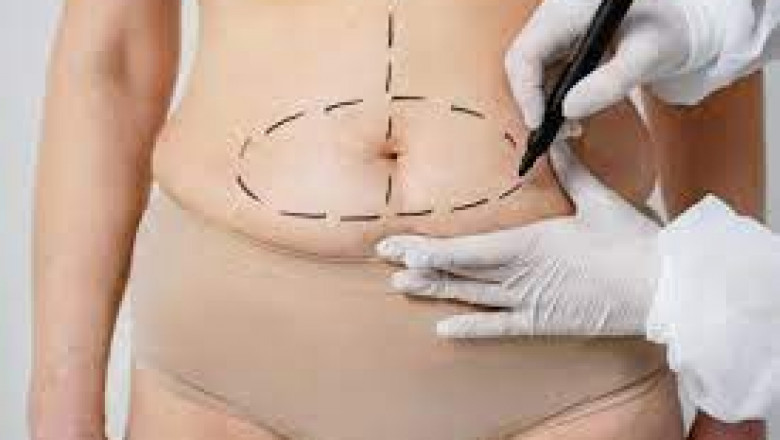 What Should I Wear After Tummy Tuck Surgery?
