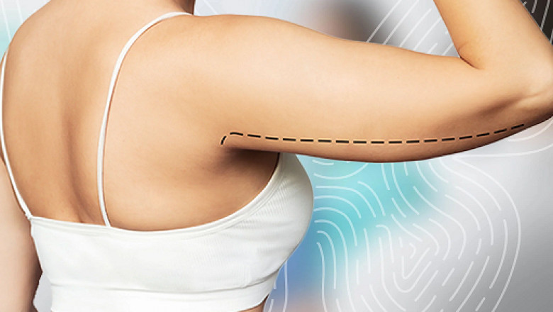 Combining Liposuction and Brachioplasty Safely