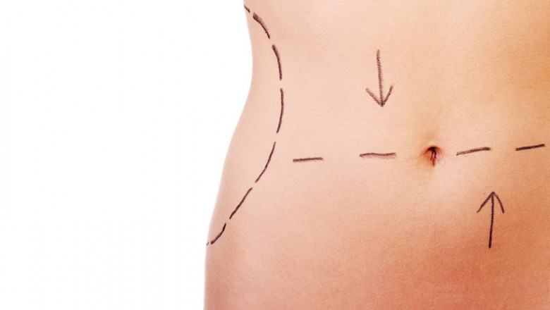 How Modesty Is Respected During Tummy Tuck in Islamabad