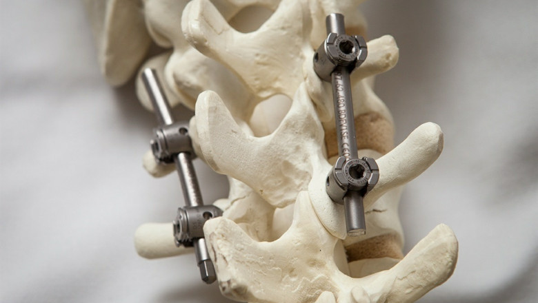 Spinal Osteosynthesis Units Market Growth and Opportunities
