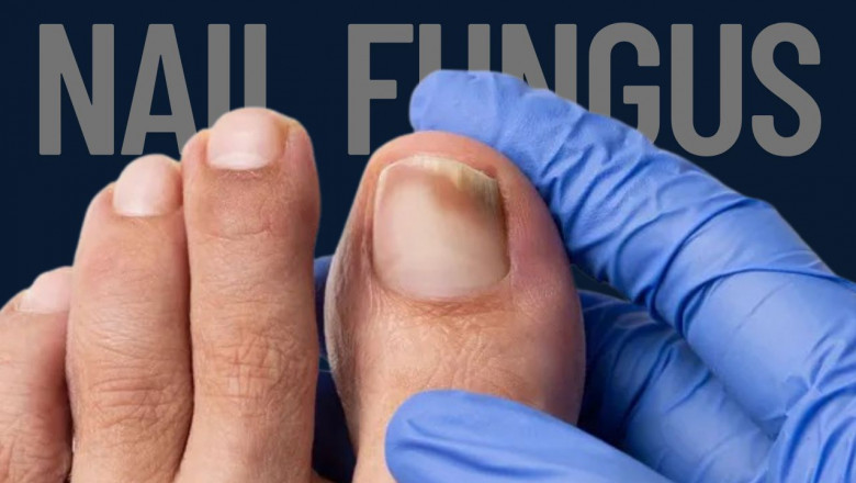 When Toenails Turn Troublesome: My Battle with Nail Fungus