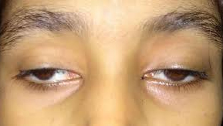 Global Ophthalmoplegia Market Growth & Investment Outlook