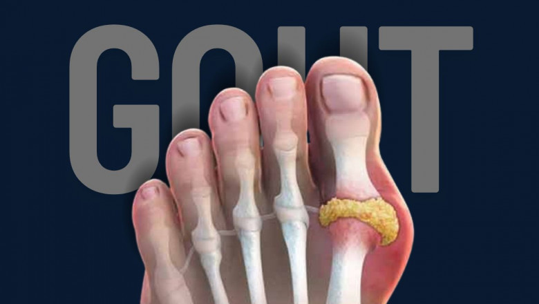 Gout Changed My Life — But Not in the Way You’d Think