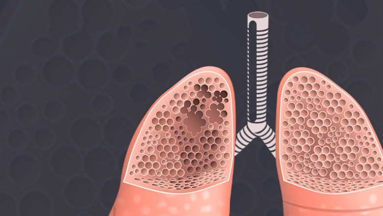 Global Emphysema Market Trends and Growth Strategies
