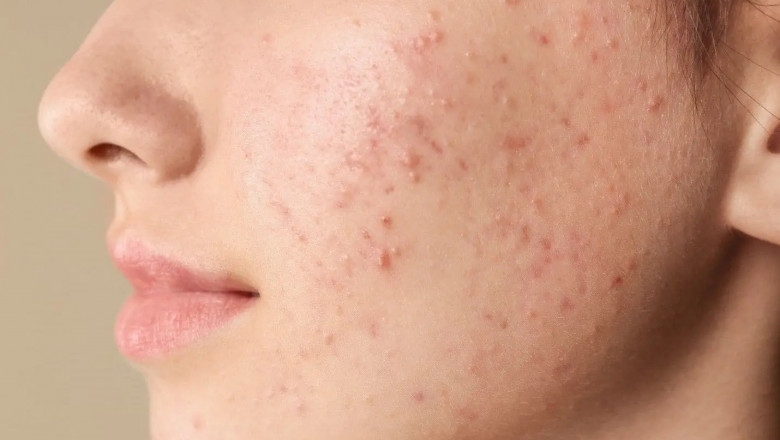 Step-by-Step Guide to Clearing Pimples Safely and Effectively