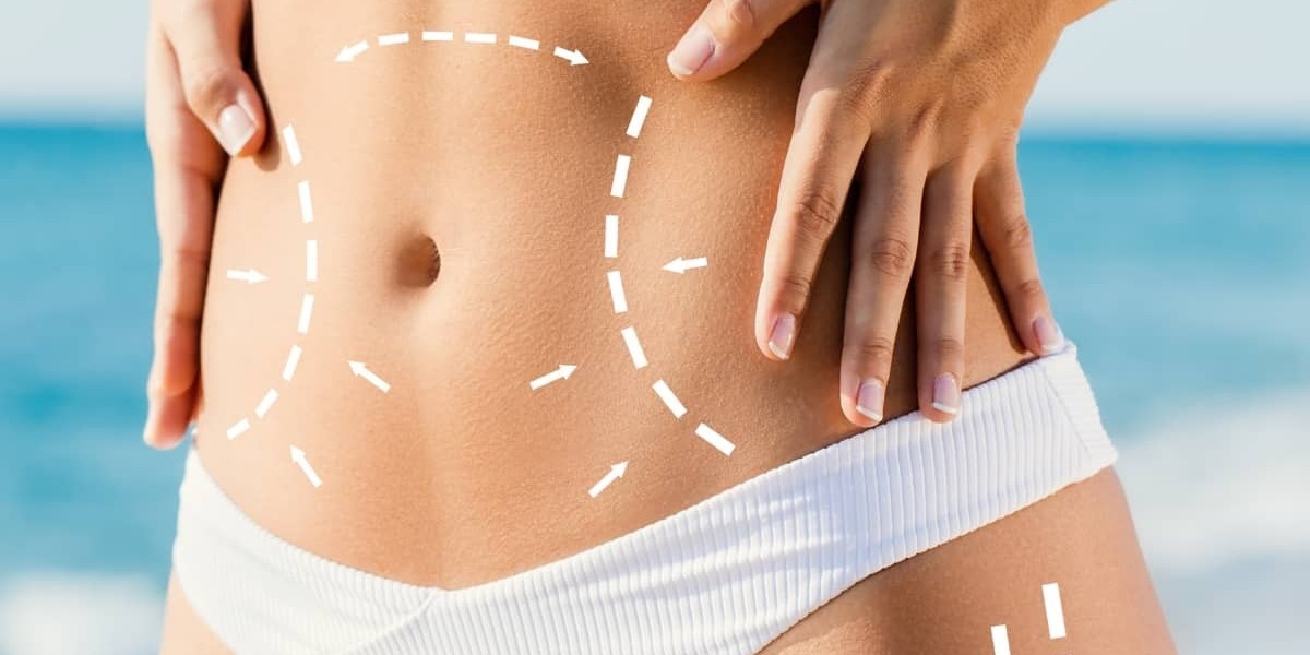 How to Prepare for Your Tummy Tuck: Essential Pre-Surgery Tips