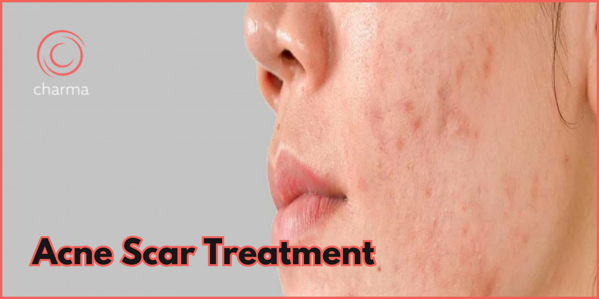 How to Treat Acne Scars?