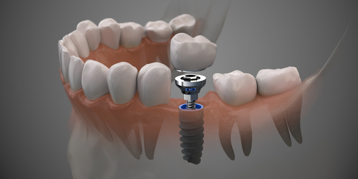 Why Choose Dubai for Your Single Tooth Implant? Top Clinics and Costs